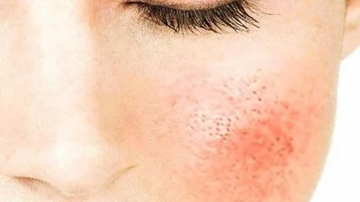 blog-400-225