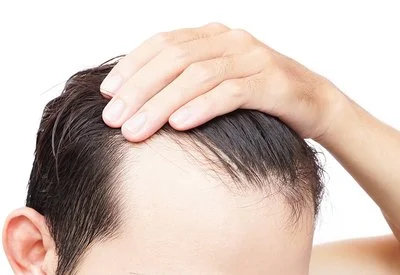 Hair Loss Hair Loss